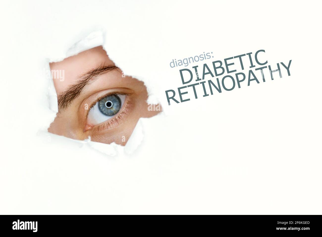 Woman`s eye looking trough teared hole in paper, words Diabetic Retinopathy on right. Eye disease concept template. White background. Stock Photo